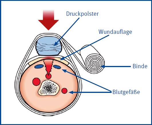 Anlegen eines Druckverbandes
