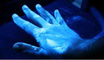 Abb. 4-13 Typisches Beispiel fr unzureichenden Hautschutz im Bereich der Fingerzwischenrume und des Daumens